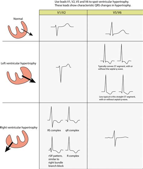 lv strain pattern ecg|criteria for lvh on ecg.